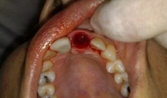 o lugar do dente extraído